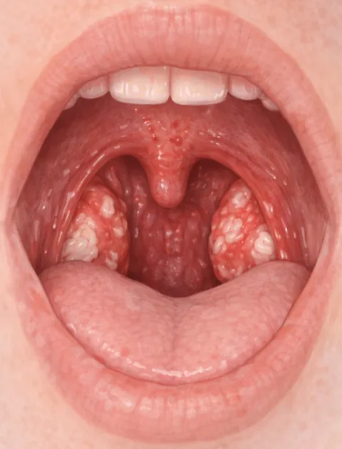 Open mouth showing red, swollen tonsils with white patches